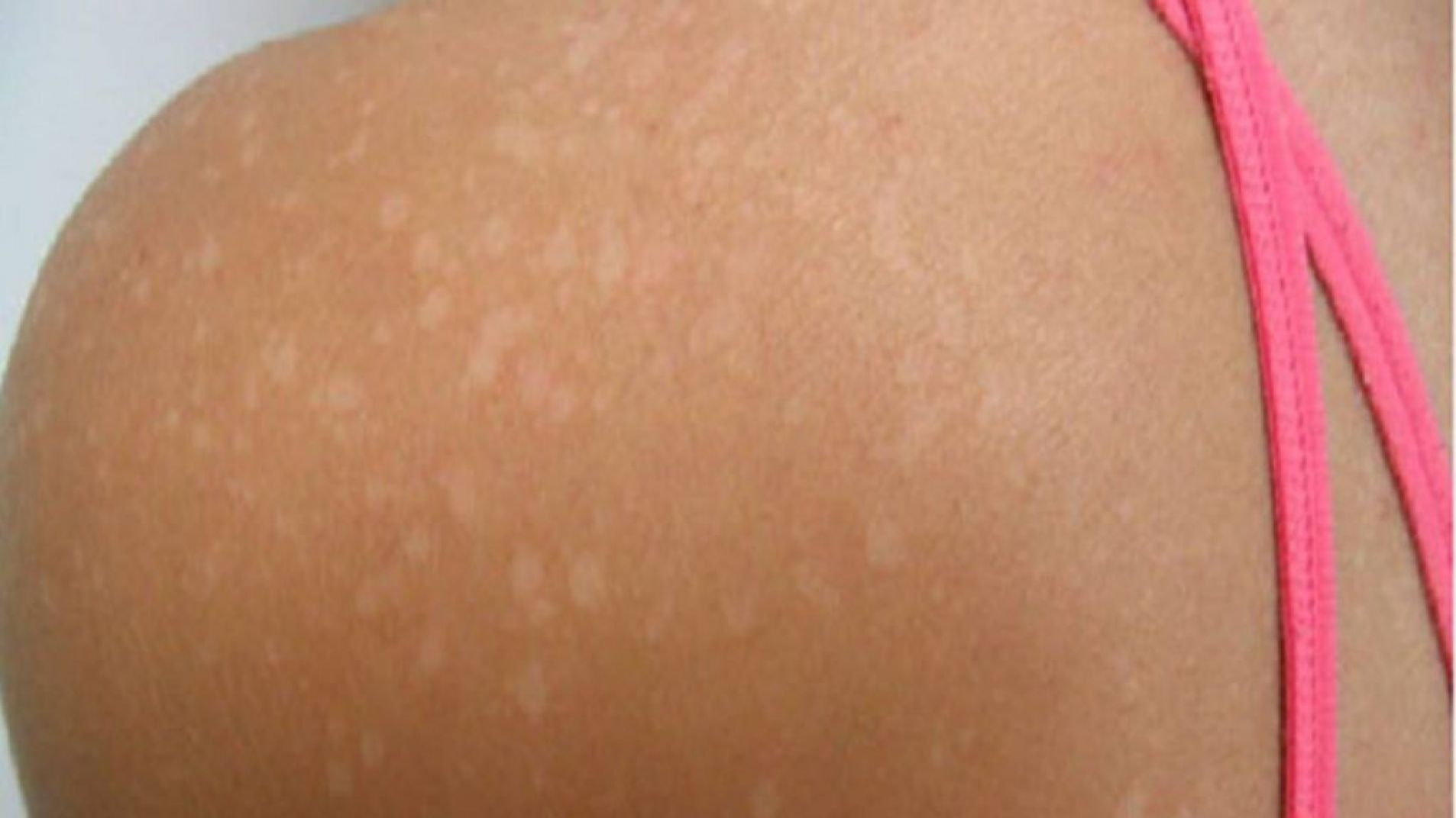 Manchitas blancas en la piel: por qué aparecen y cuáles deben tratarse